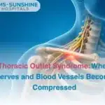 Thoracic Outlet Syndrome When Nerves and Blood Vessels Become Compressed