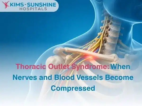 Thoracic Outlet Syndrome When Nerves and Blood Vessels Become Compressed